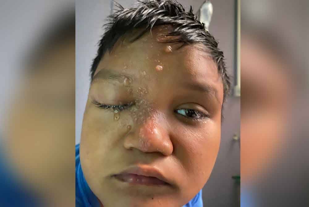 Keadaan kayap di bahagian muka Adam selepas menerima suntikan antibiotik.