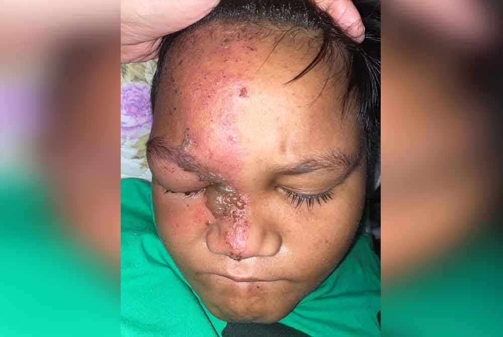 Keadaan Adam ketika didiagnoskan penyakit kayap pada 3 April.