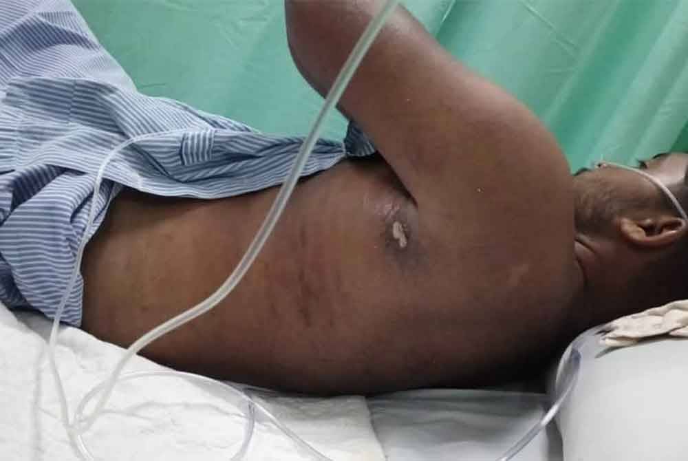 Keadaan badan Muhamad Nursyarif yang dipenuhi sengatan obor-obor.