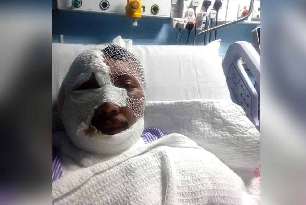 Edy Anuar mengalami lecuran 30 peratus dan akan menjalani pembedahan bagi membuang kulit mati Khamis ini. Foto ihsan pembaca