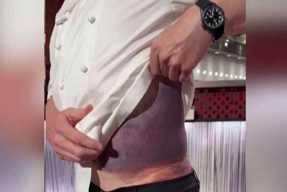 Sambil mengangkat bajunya, Ramsay menunjukkan lebam yang sangat besar, chef itu menegaskan kepentingan memakai topi keledar ketika berbasikal. - Foto: Agensi