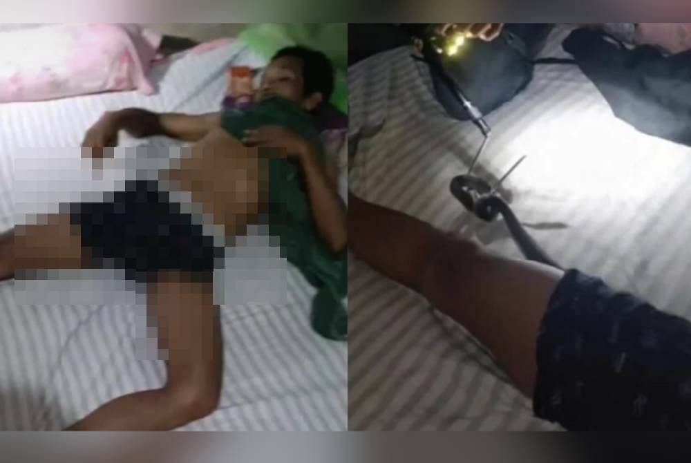 Seorang lelaki menahan nafas semasa operasi mengeluarkan ular dalam boxer di Rayong, Thailand. Agensi