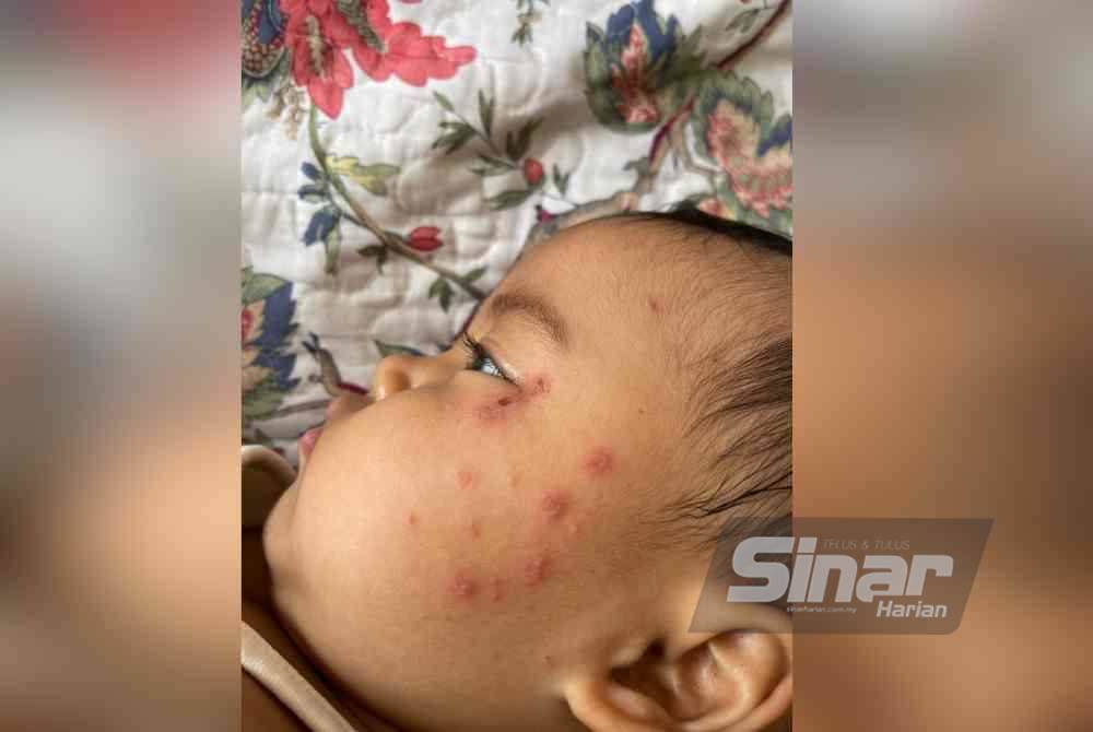 Ivy mengalami kesan bengkak dan kemerahan pada bahagian muka.