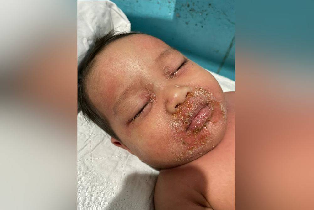 Keadaan Khadeeja ketika kulitnya seakan-akan melecur.