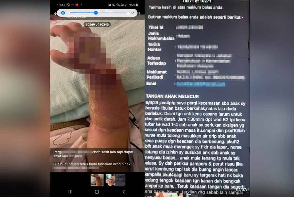 Seorang bayi berusia satu bulan didakwa mengalami bengkak dan melecur di tangan selepas mendapat rawatan di hospital.