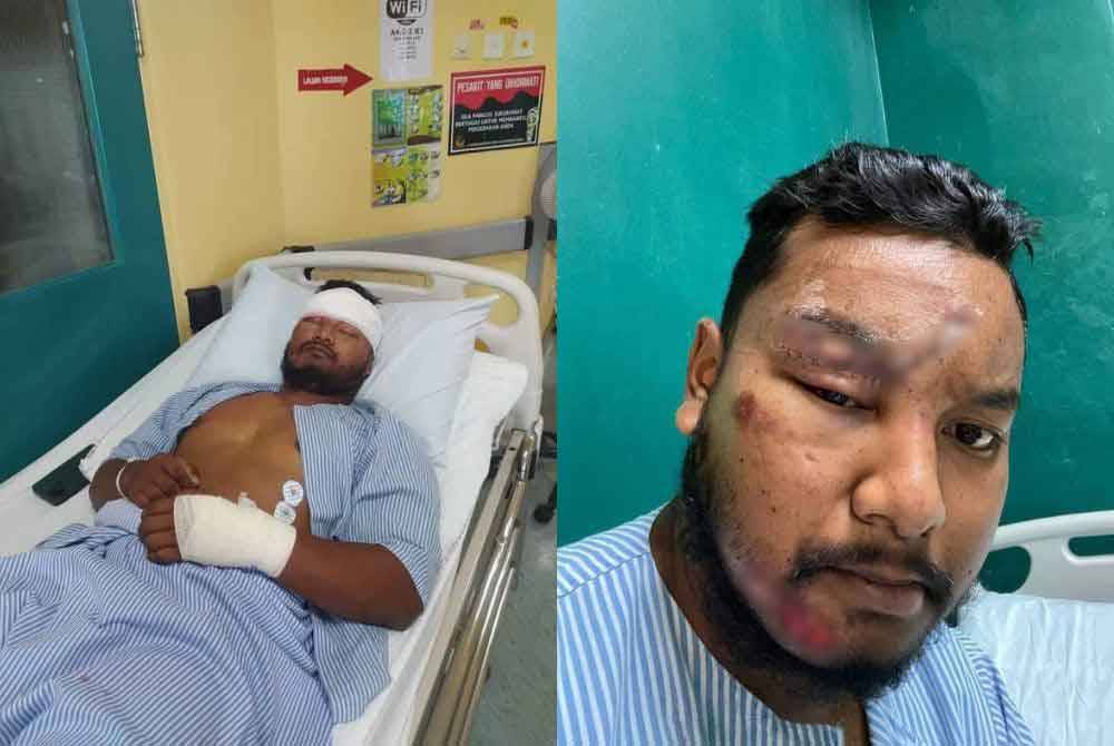 CEO Batu menerima lebih 20 jahitan selepas terlibat dalam kemalangan di Sungai Petani.