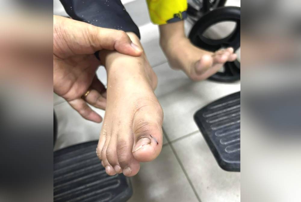 Ibu jari kaki kanan turut tertusuk duri landak laut.