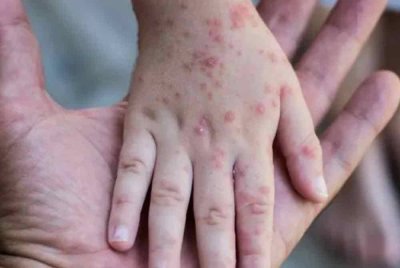 Thailand mungkin mencatatkan kes pertama strain mpox baharu yang lebih mudah berjangkit daripada seorang lelaki Eropah. Foto hiasan