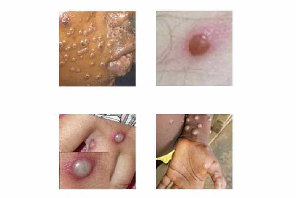 Antara gejala Mpox adalah seperti demam berserta ruam “maculopapular rash” atau lepuh pada muka, tapak tangan, tapak kaki, kemaluan, konjunktiva dan kornea. Foto CDC