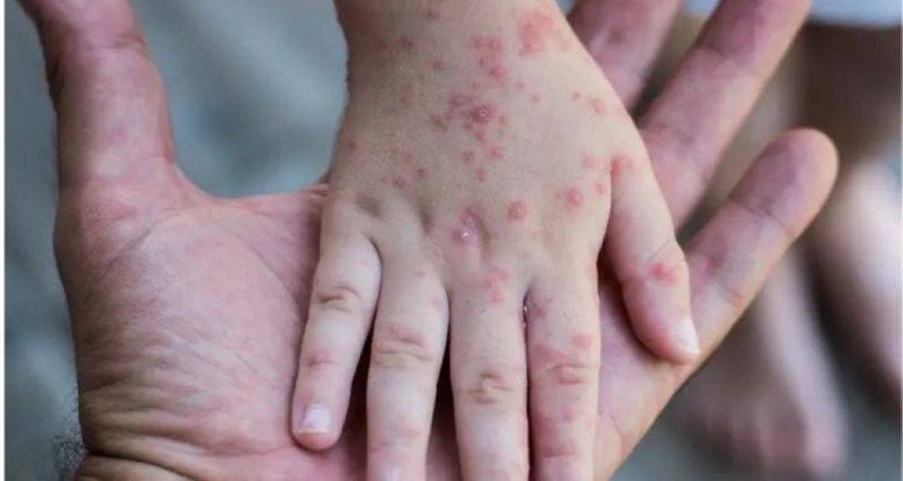 JKNJ kini sudah bersiap siaga sebagai respons kepada kecemasan kesihatan awam kebimbangan antarabangsa atau PHEIC yang diisytiharkan WHO - Gambar hiasan