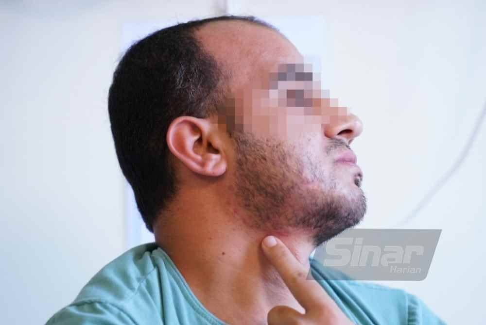 Kesan kecederaan yang dialami oleh Mohamed Sufyan di bahagian rahangnya akibat terkena serpihan bom. Foto Sinar Harian-MOHD HALIM ABDUL WAHID