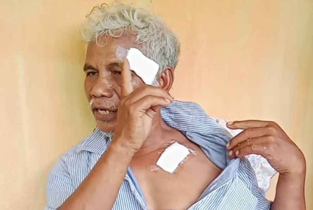 Arshad menunjukka kecederaan yang dialaminya.