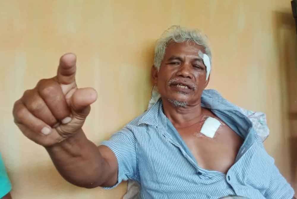 Arshad menunjukkan kedalaman luka pada dadanya akibat disondol kerbau betina.