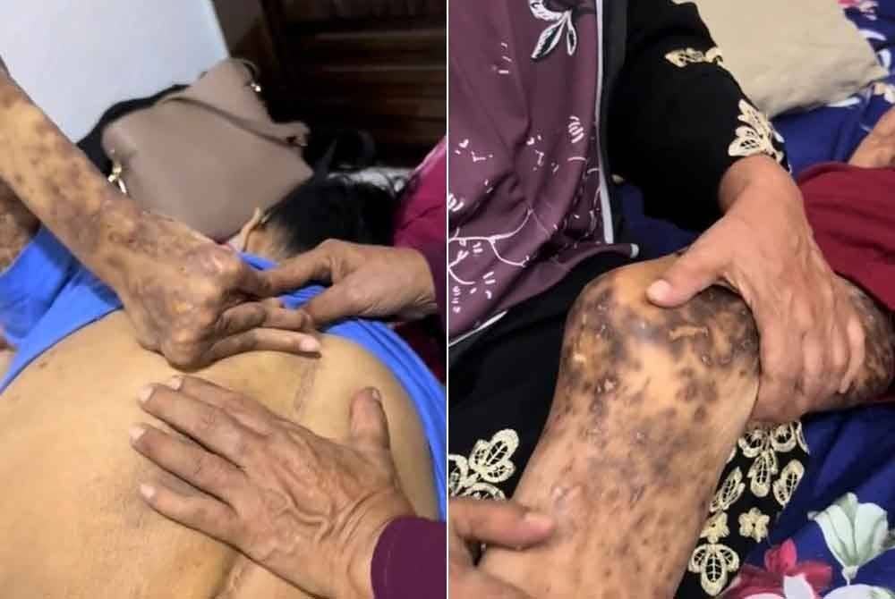 Gambar kiri: Keadaan tulang belakang Iwan selepas melalui beberapa operasi tulang belakang. Gambar kanan: Ligamen PCL Iwan yang terputus. Sumber: Tiktok @idzwanjohari91 (Senyuman OKU)