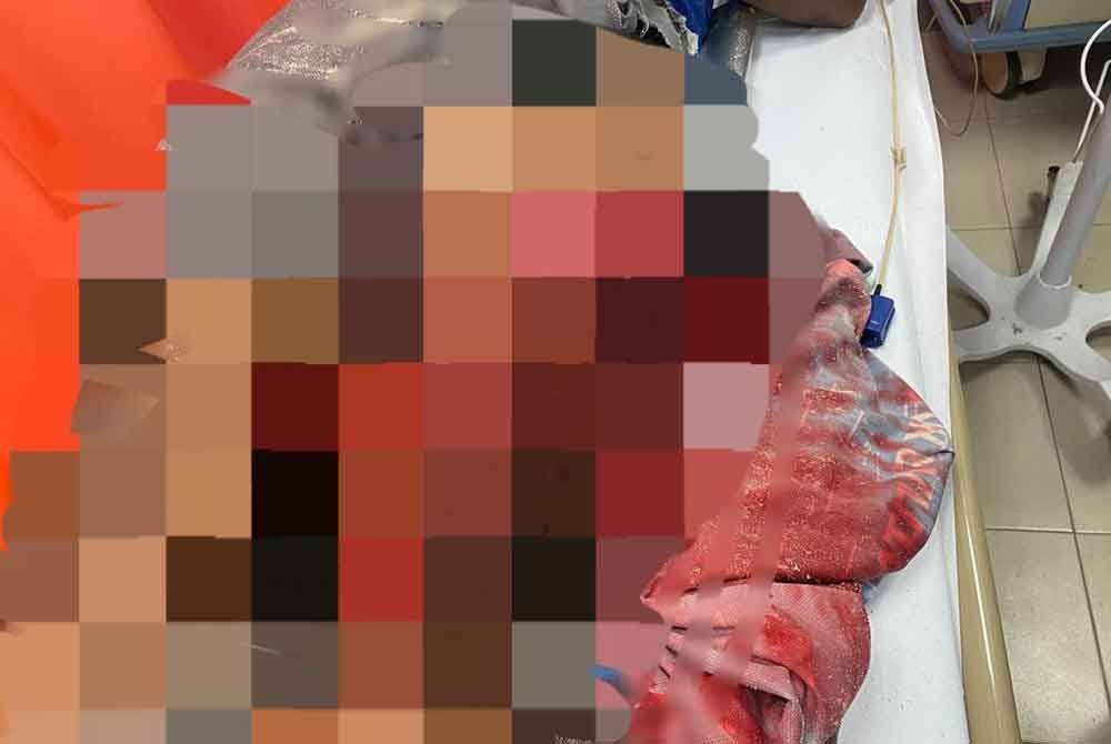 Seorang pembantu pengemudi bot cedera parah di bahagian paha kiri akibat terkena kipas bot di Pulau Redang. Foto: PDRM