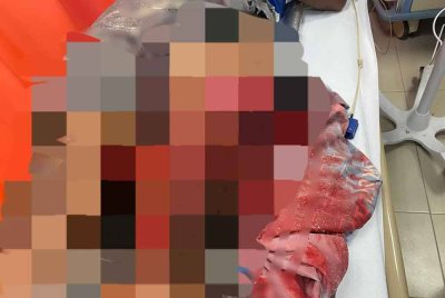 Seorang pembantu pengemudi bot cedera parah di bahagian paha kiri akibat terkena kipas bot di Pulau Redang. Foto: PDRM