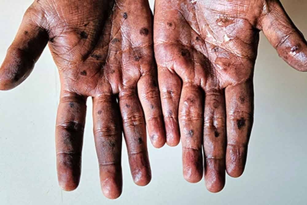 Varian baharu clade Ib virus mpox telah dikesan buat kali pertama di Jerman. Gambar hiasan