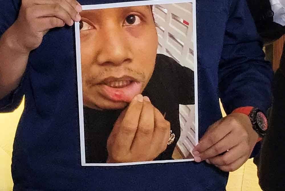 Muhammad Nur Hakim menunjukkan bibirnya mengalami cedera selepas insiden itu.