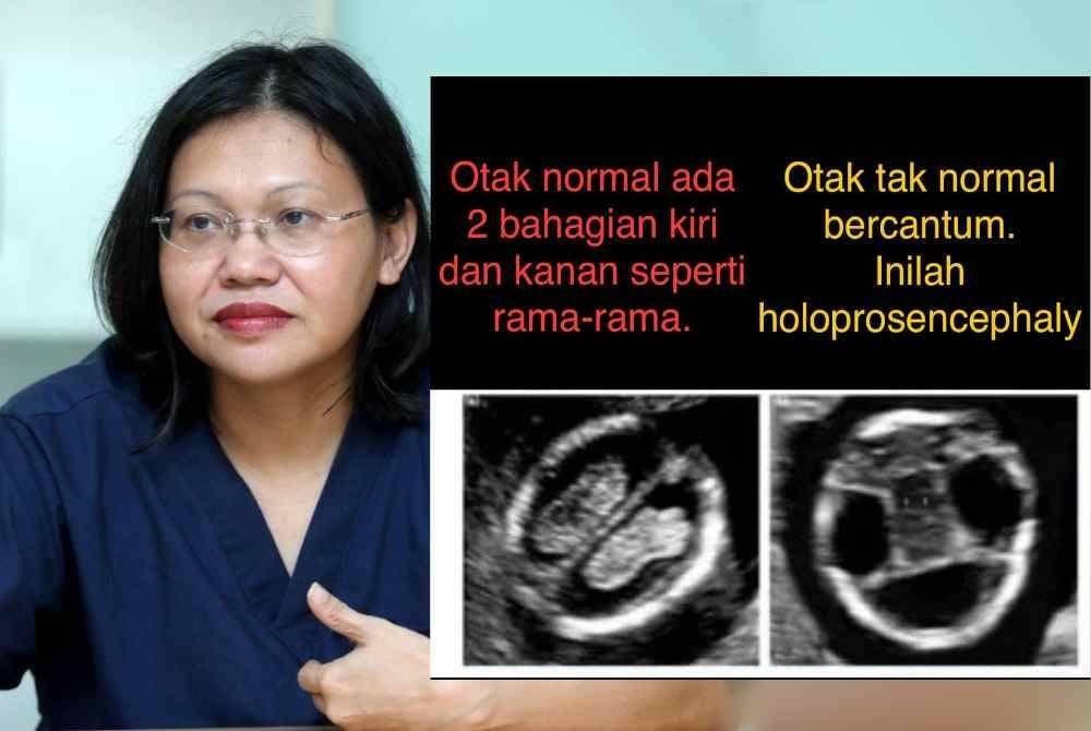 Dr Imelda berkata, masalah itu boleh dikesan melalui imbasan ultrabunyi 2D yang terperinci seawal 11 minggu kehamilan.