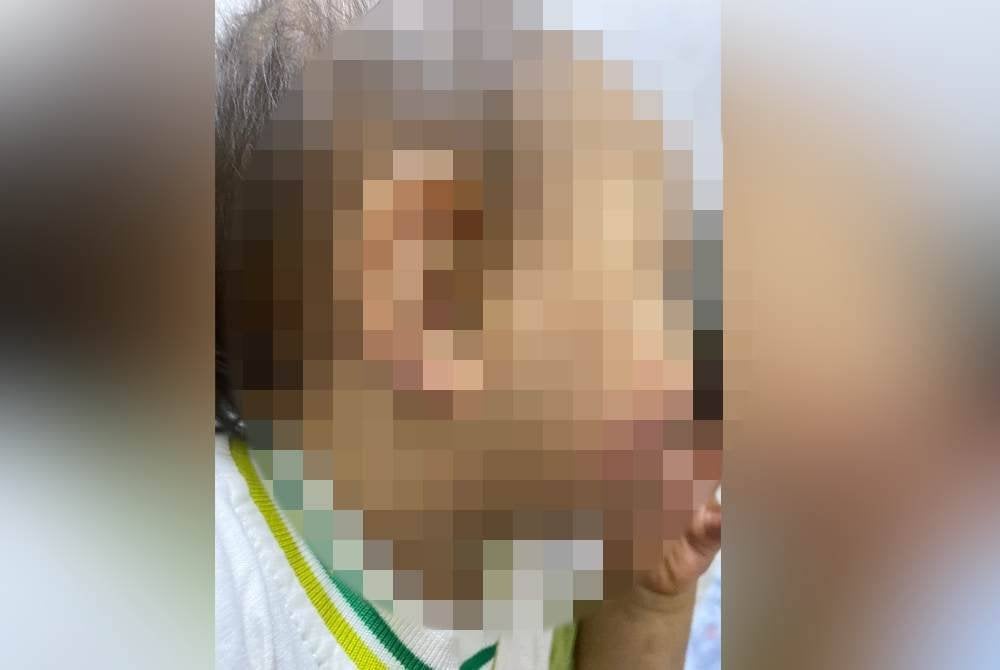 Kesan kecederaan pada telinga dan pipi bayi lelaki 11 bulan disyaki didera seorang guru taska di Puncak Alam.