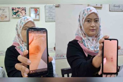 Aiza Salzul Hanira menunjukkan kesan lebam di tapak tangan anaknya didakwa kesan cubitan. Antara kesan kecederaan yang dialami anak Aiza Salzul Hanira dibadan didakwa didera guru.