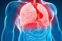 TB menyerang paru-paru, tetapi juga boleh menjejaskan organ lain. Gambar hiasan