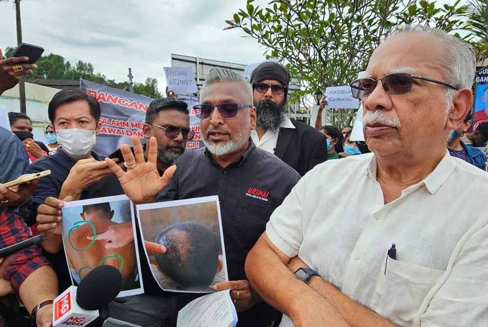 Ramasamy (kanan) menunjukkan kecederaan yang dialami banduan didakwa dipukul oleh warden penjara.