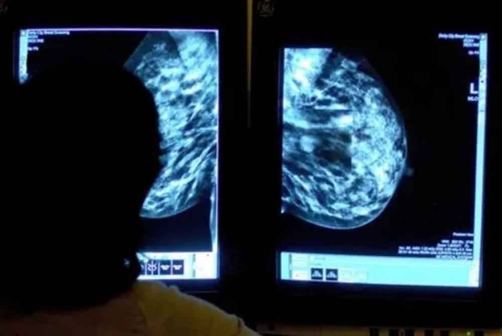 Hampir 700,000 wanita di UK akan mengambil bahagian dalam ujian skala besar yang dijalankan NHS untuk menilai penggunaan AI dalam penyaringan kanser payudara - Foto: Agensi