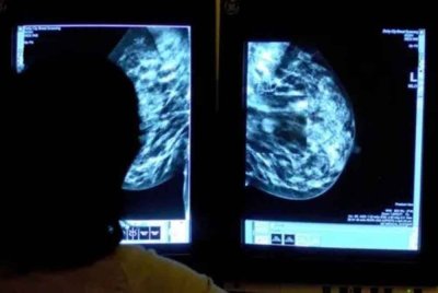Hampir 700,000 wanita di UK akan mengambil bahagian dalam ujian skala besar yang dijalankan NHS untuk menilai penggunaan AI dalam penyaringan kanser payudara - Foto: Agensi