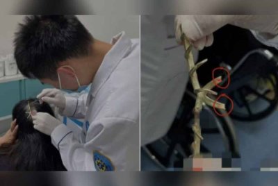 Doktor mengeluarkan sepit rambut yang tertusuk di kepala wanita ketika kemalangan jalan raya - Foto: Agensi