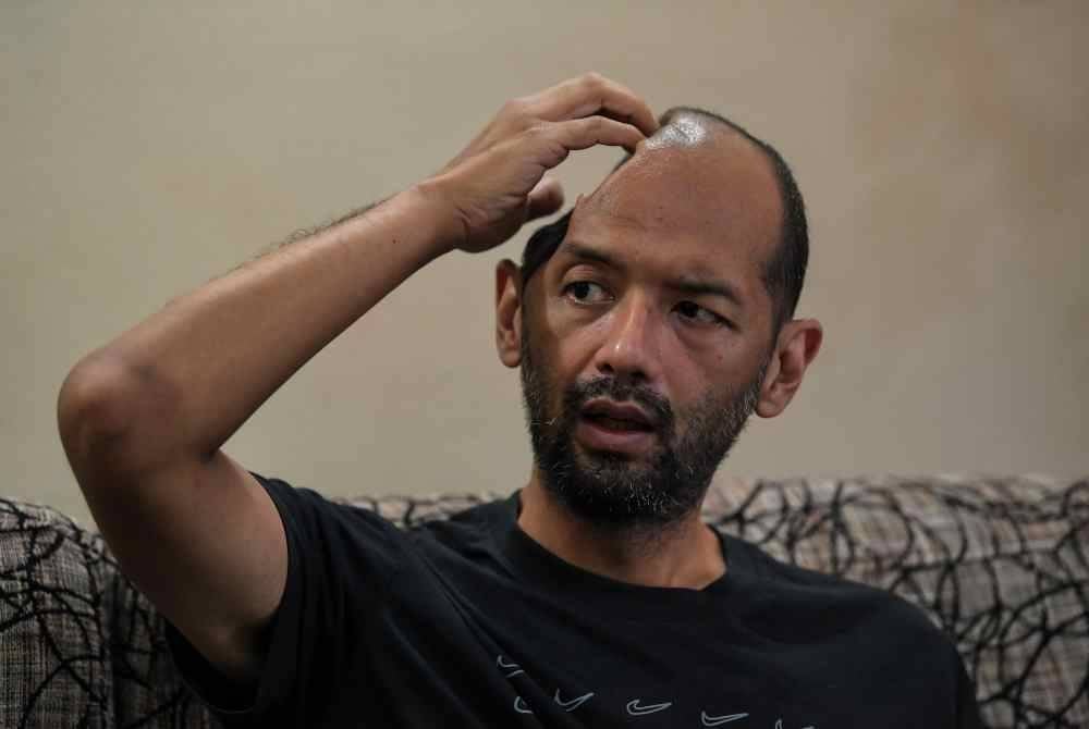 Muhammad Sufi menunjukkan bahagian tempurung kepala bahagian kanannya terpaksa dibuang akibat pendarahan otak yang serius berikutan terlibat dalam kemalangan pada Disember 2023. Foto Bernama