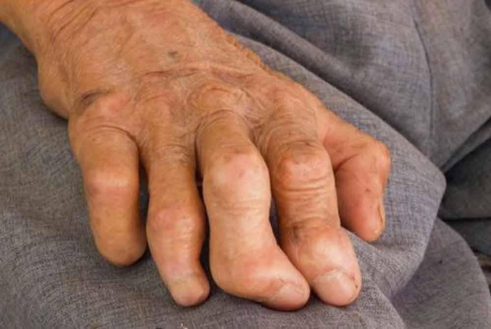 Kes kusta baharu dalam negara meningkat sebanyak 40 peratus kepada 256 kes pada tahun 2023 berbanding 183 kes tahun sebelumnya. Gambar hiasan