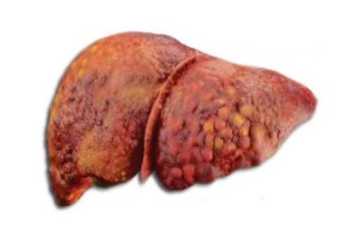 Peningkatan mendadak kes kanser hati di Malaysia telah mencetuskan kebimbangan serius dalam kalangan pakar kesihatan, dengan penyakit hati berlemak menjadi penyebab utama.