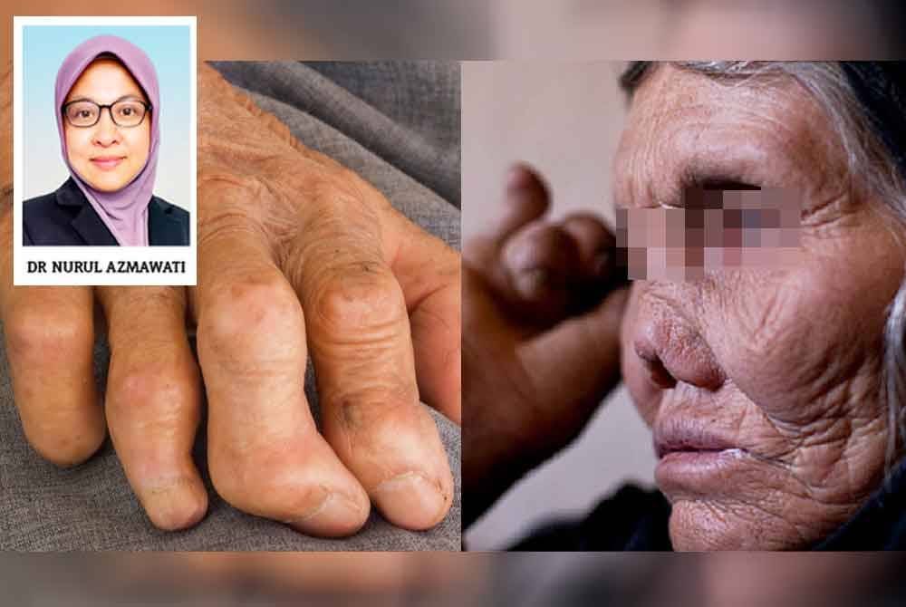 Kusta ialah jangkitan bakteria Mycobacterium leprae yang menyerang sel kulit dan saraf periferi menyebabkan perubahan progresif pada kulit serta kehilangan fungsi saraf - Gambar hiasan