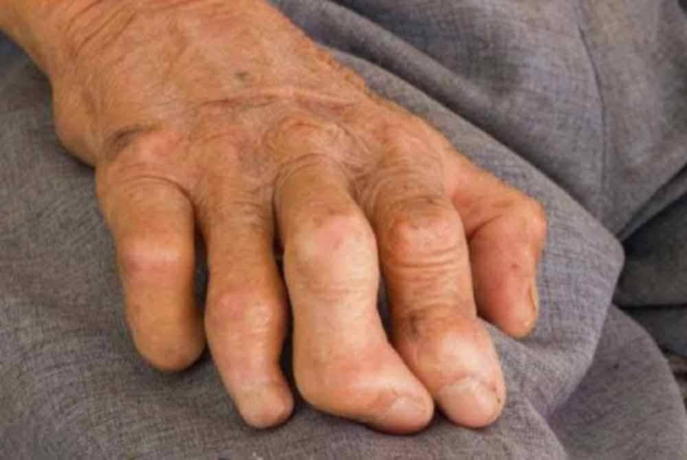 Sembilan kes disahkan kusta dan kesemua pesakit telah diberi rawatan mengikut regim garis panduan ditetapkan. Foto hiasan