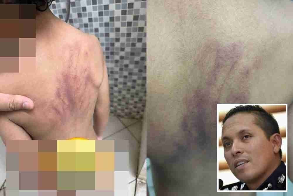 Belakang badan kanak-kanak autisme lebam, didakwa didera di taska. Gambar kecil: Mohd Iqbal