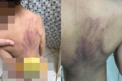 Belakang badan kanak-kanak autisme lebam, didakwa didera di taska. Kredit Facebook Nazmi Zulkifli.