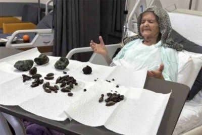 Seorang warga emas berusia 92 tahun di Turki didapati mempunyai 63 biji batu kecil dan lima ketul batu sebesar penumbuk di dalam perut dan ususnya. Foto sumber Must Share News
