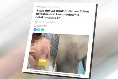 Laporan Sinar Harian berhubung seorang bapa mendakwa anak autisme didera di taska, ada kesan lebam di belakang badan.