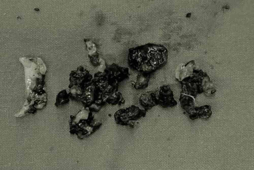 Bebola kulat yang berada dalam hidung sebelah kanan wanita berkenaan. Foto sumber ETtoday