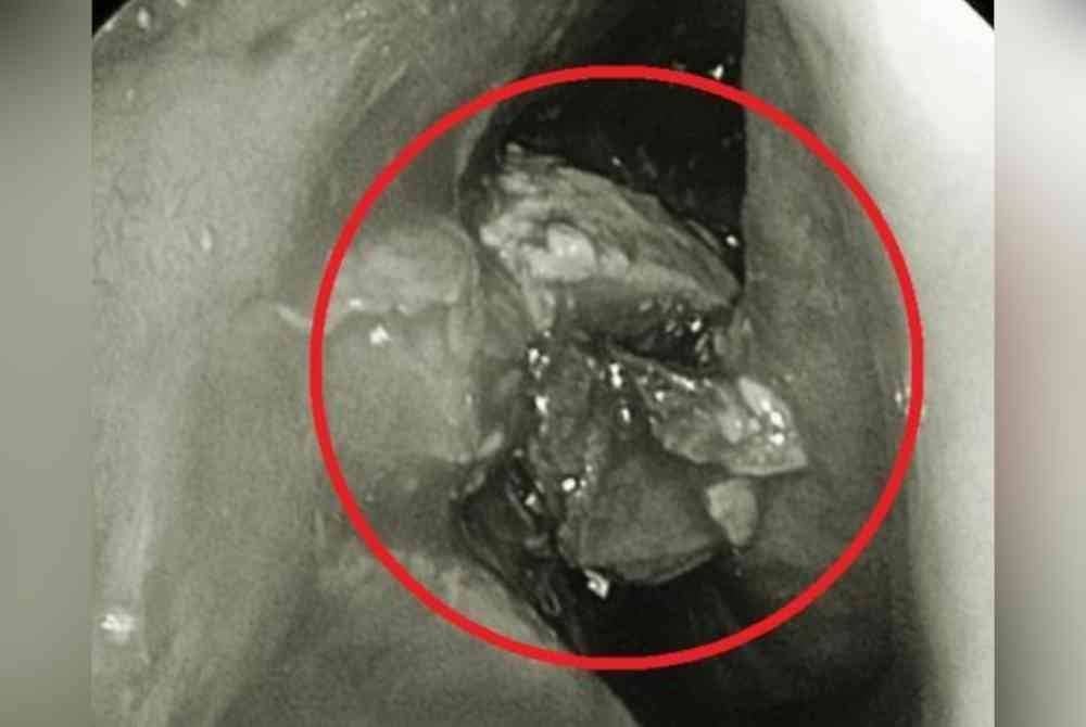 Ketulan bebola kulat yang berada di sebelah kanan hidung wanita berkenaan. Foto sumber ETtoday