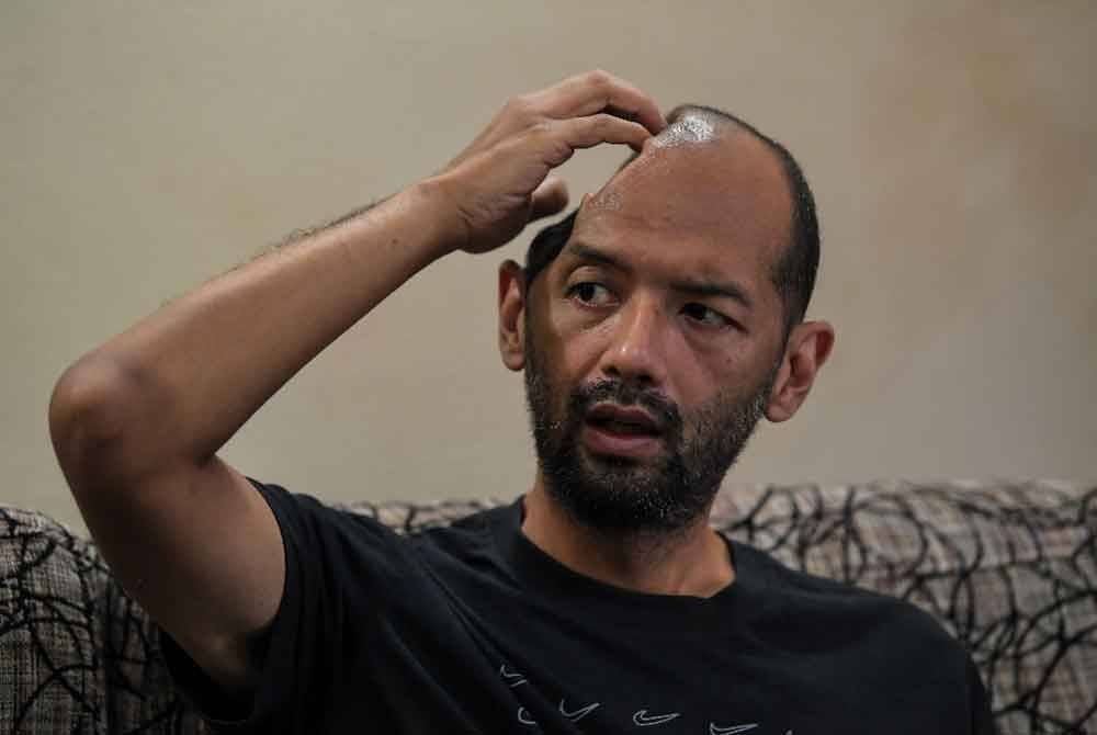 Muhammad Sufi Abdul Aziz,36 menunjukkan bahagian tempurung kepala bahagian kanannya terpaksa dibuang akibat pendarahan otak yang serius berikutan terlibat dalam kemalangan pada Disember 2023. Foto Fail Bernama