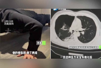 Imbasan sinar-X (kanan) menunjukkan paru-paru seorang lelaki mengecut sebanyak satu pertiga daripada saiz asal selepas dia melakukan senaman tekan tubi dan lompat tali. Foto Agensi
