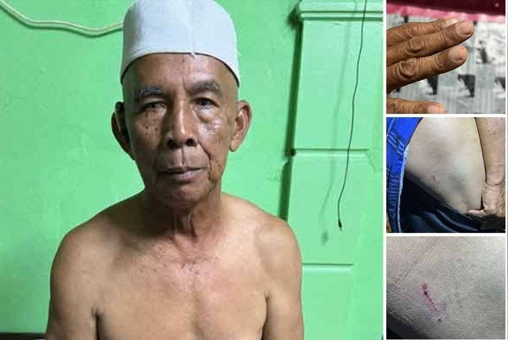 Kecederaan yang dialami mangsa selepas digigit anjing liar dalam kejadian Isnin lalu.