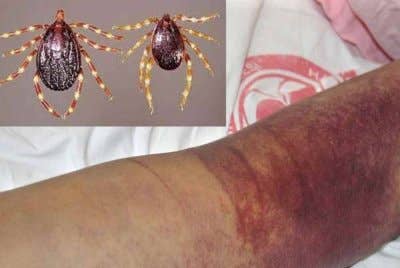 Kementerian Kesihatan Uganda mengesahkan pada Jumaat wabak demam berdarah Crimean-Congo (CCHF) di Daerah Kyegegwa, wilayah barat negara itu - Foto: Agensi