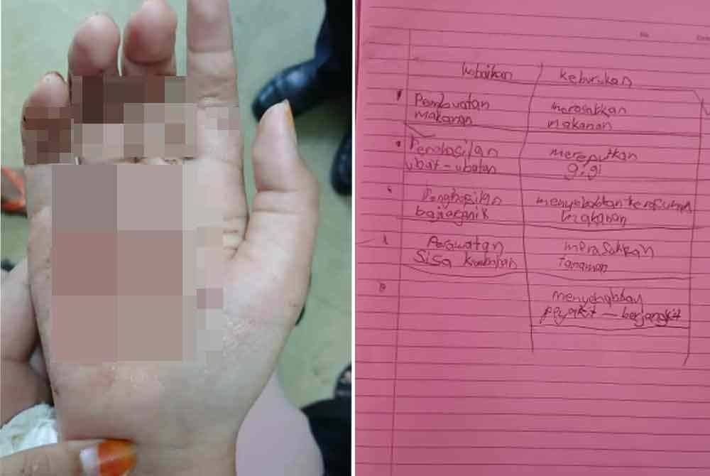 Keadaan tapak tangan kanan Nasuha selepas balutan dibuka. Foto kanak: Nasuha kini berlatih menulis menggunakan tangan kiri susulan kecederaan tangan kanan yang dialami.