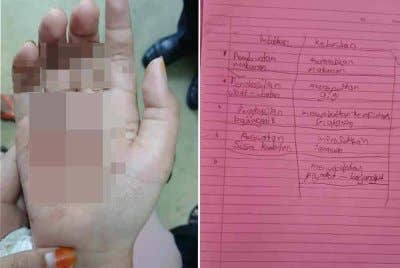 Keadaan tapak tangan kanan Nasuha selepas balutan dibuka. Foto kanak: Nasuha kini berlatih menulis menggunakan tangan kiri susulan kecederaan tangan kanan yang dialami.