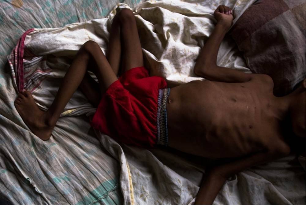 Sekurang-kurangnya 14 juta kanak-kanak di seluruh dunia sedang menderita akibat malnutrisi. Foto arkib dpa
