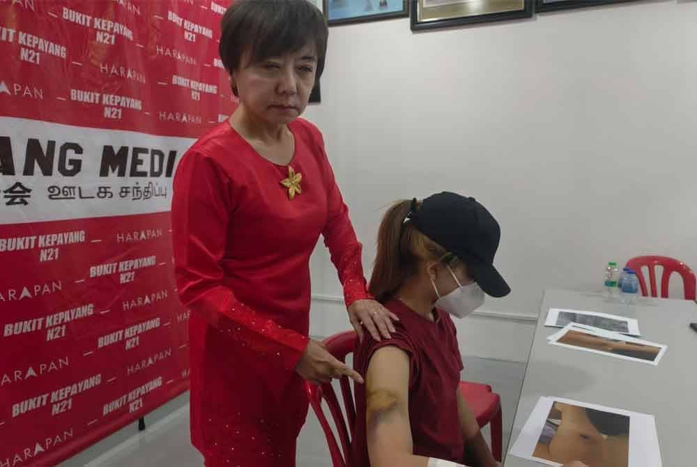 Nicole (kiri) menunjukkan kesan luka dialami Low selepas dikasari suami dalam kejadian Selasa.