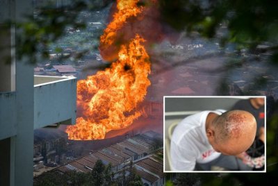 Antara kecederaan melecur di tangan yang dialami Mohd Khairul rentetan peristiwa tersebut.